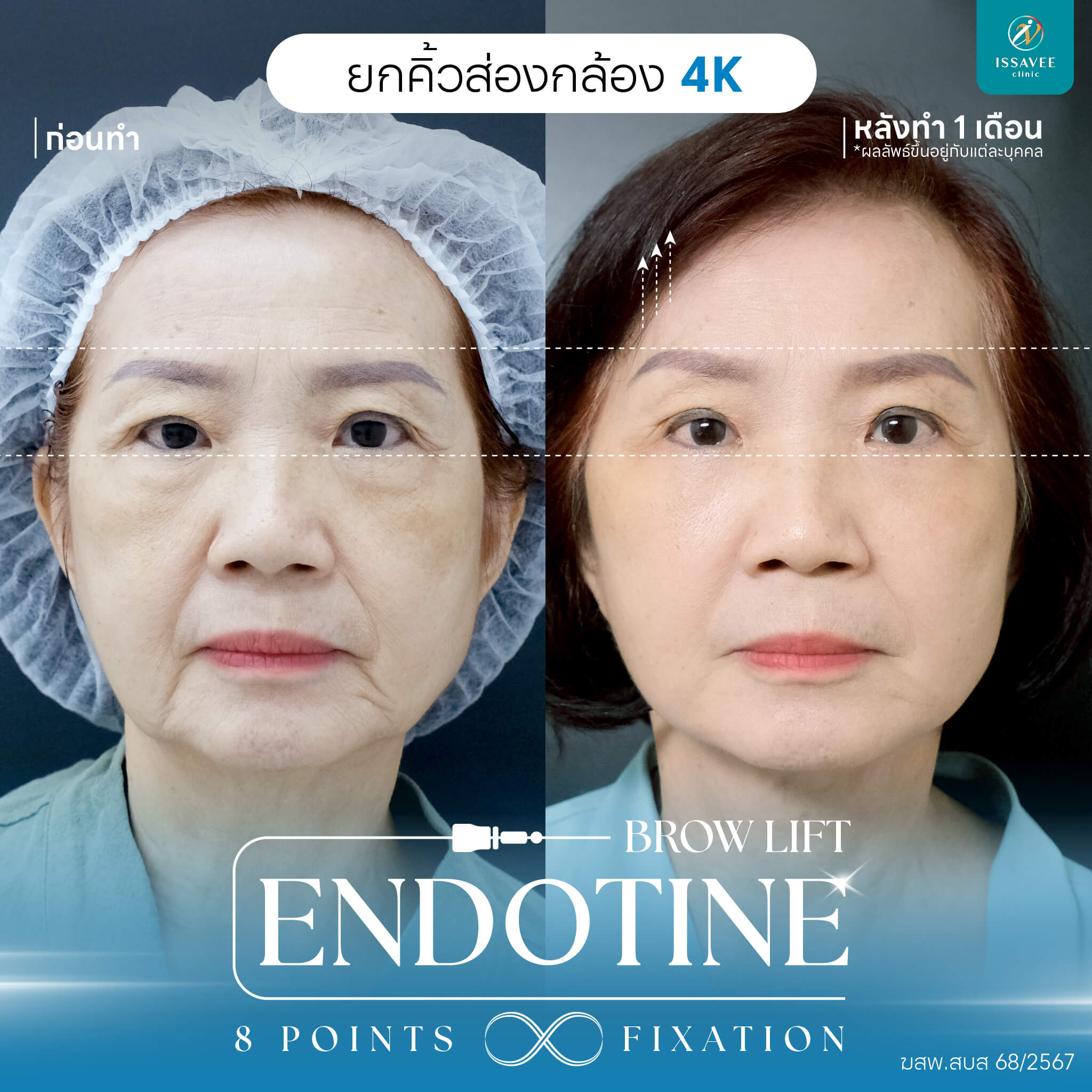 Endotine (เอนโดไทน์) ดึงหน้า ยกคิ้ว แก้ปัญหาคิวตก ตาตก