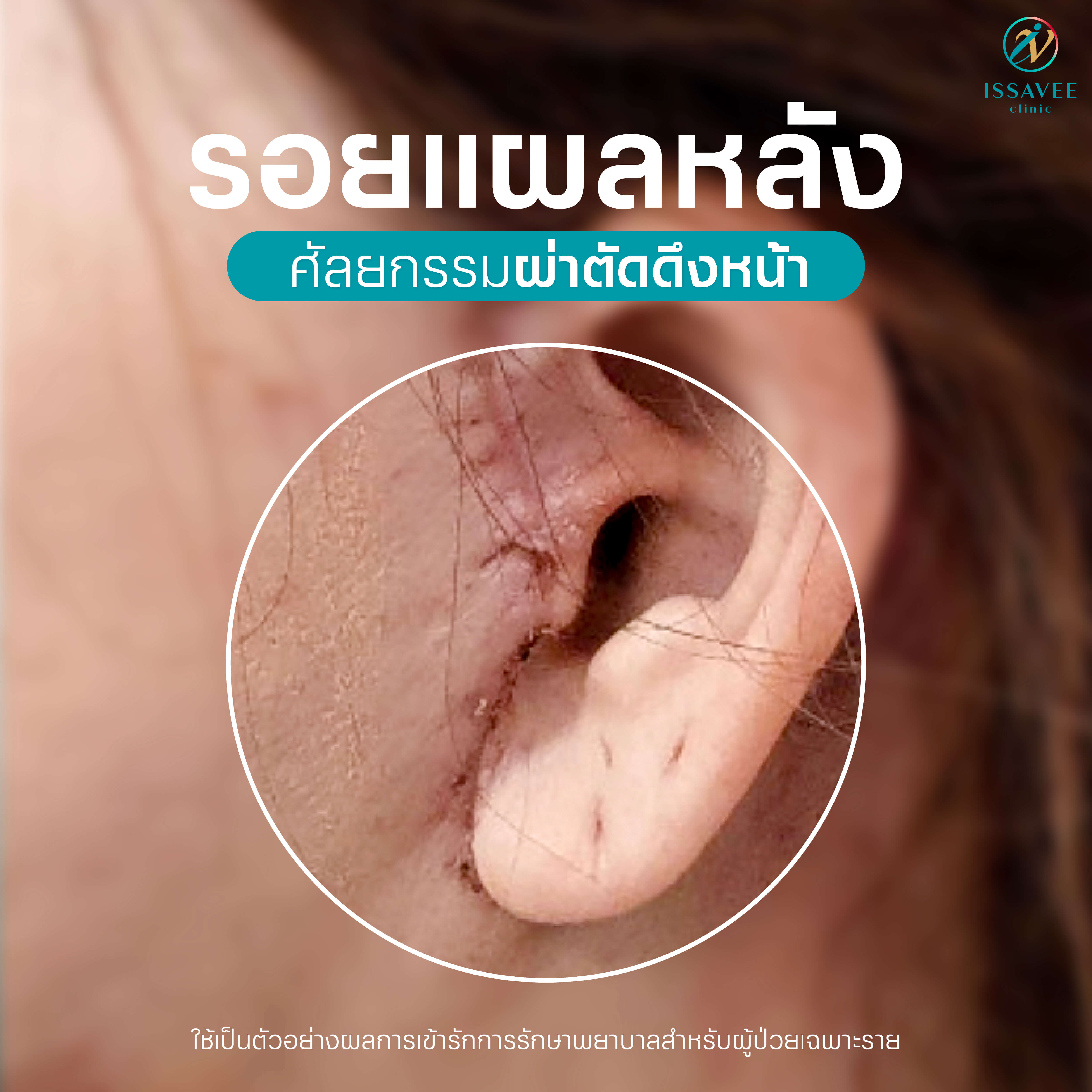 รอยแผลหลังทำศัลยกรรมผ่าตัดดึงหน้า