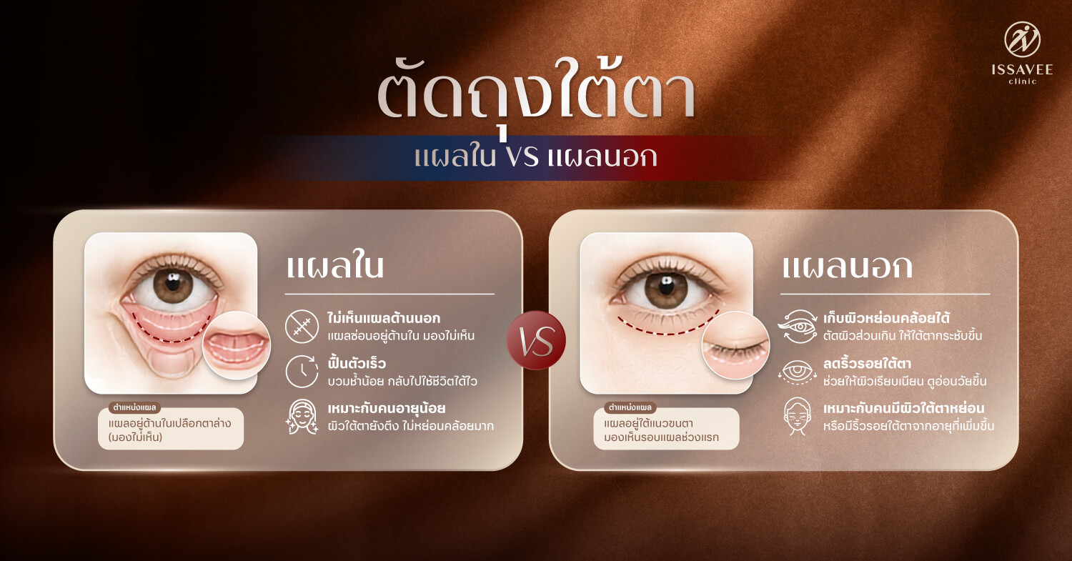 เปรียบเทียบตัดถุงใต้ตาแบบแผลในและแผลนอก