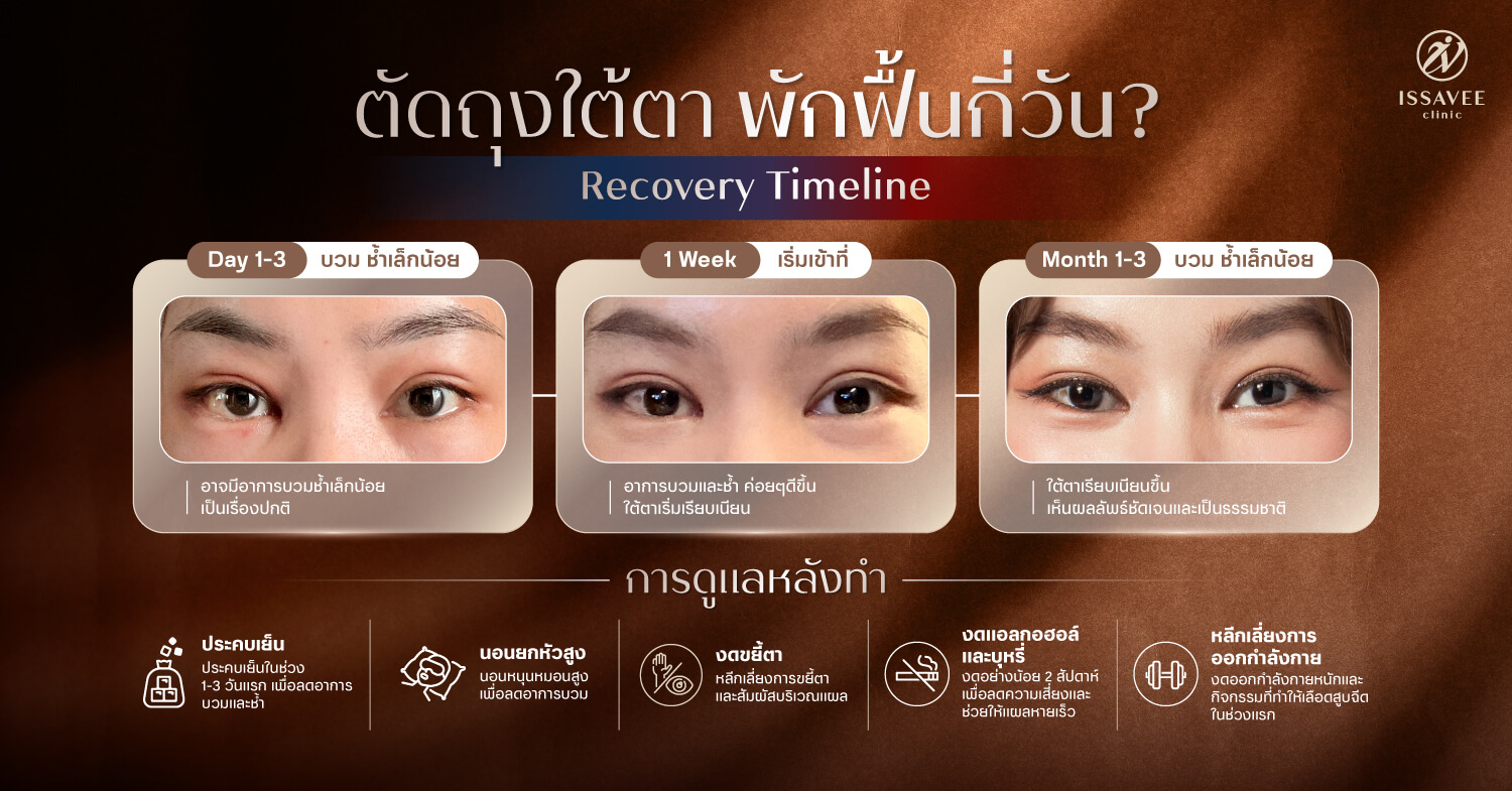 "ขั้นตอนและระยะพักฟื้นหลังตัดถุงใต้ตา"