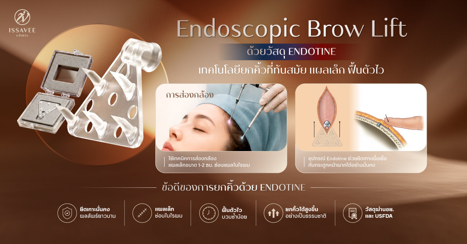 "เทคนิคยกคิ้วส่องกล้องด้วย Endotine"