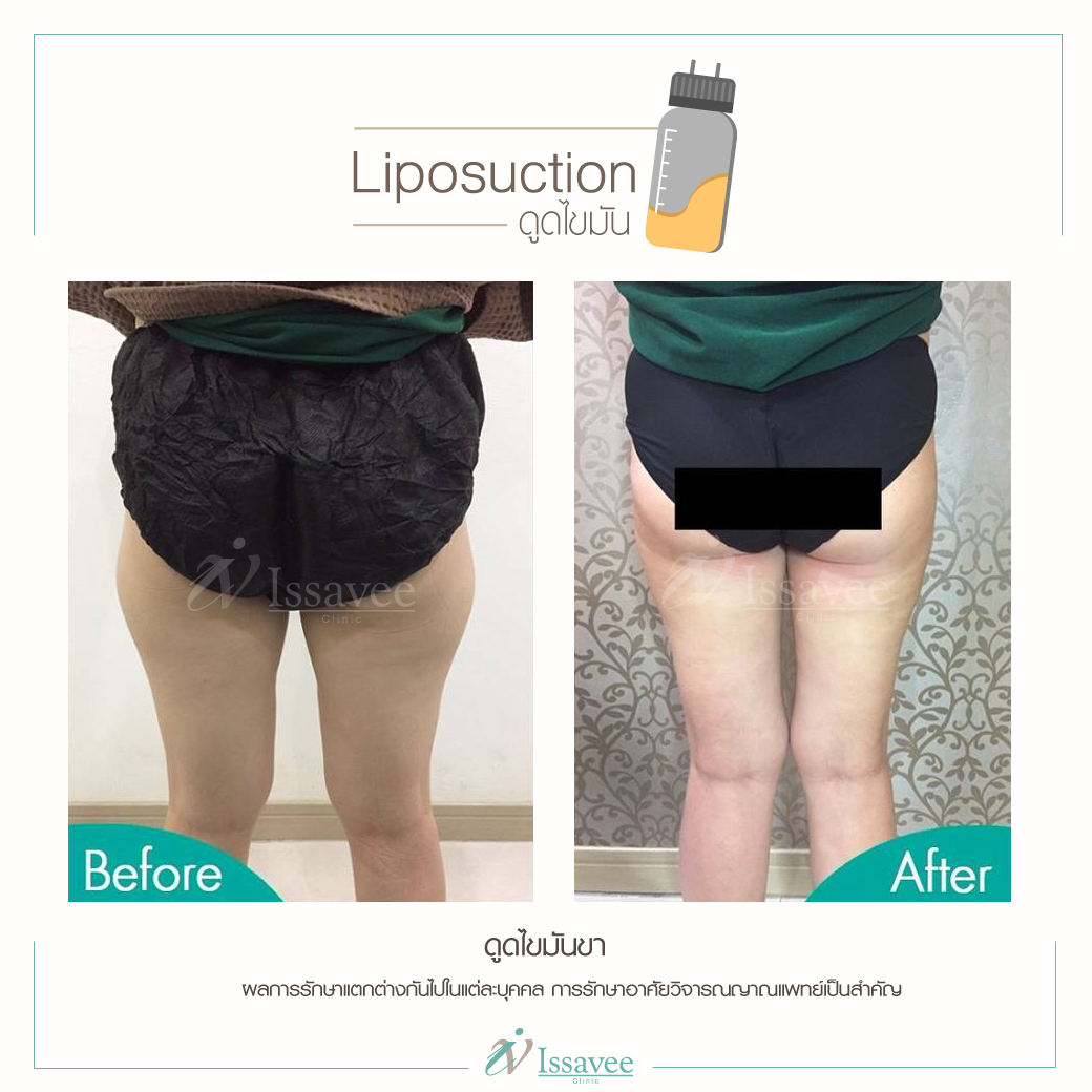 Liposuction To Lose Weight