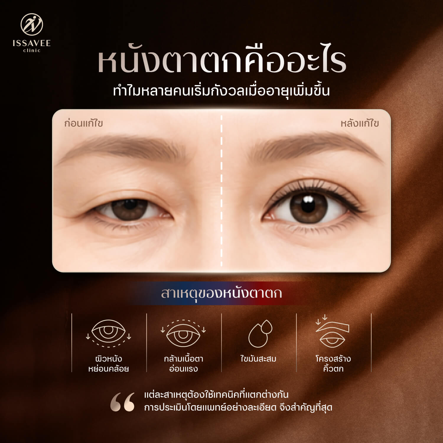 ลักษณะหนังตาตกที่ทำให้ชั้นตาหาย ตาดูง่วง และดูแก่กว่าวัย