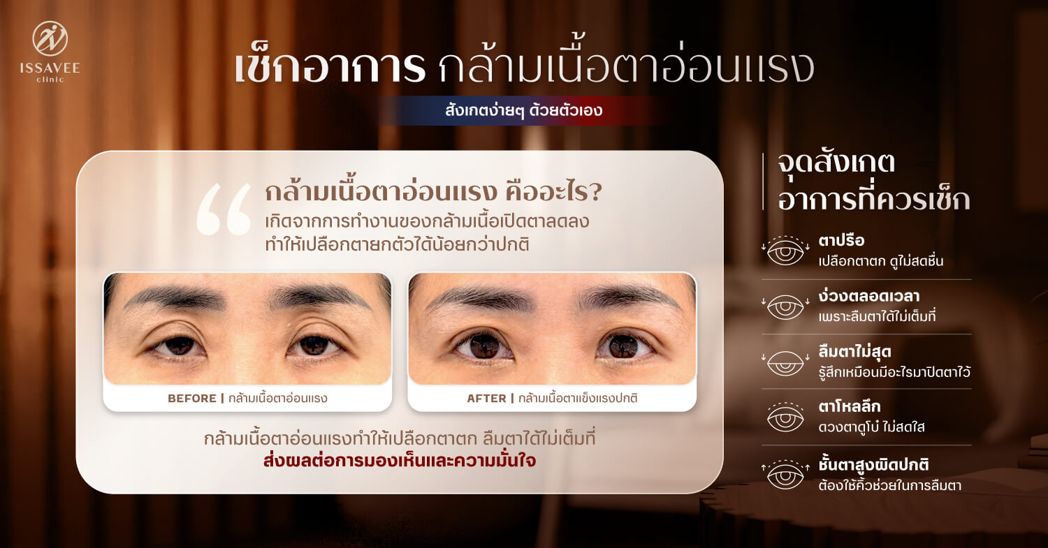 การประเมินกล้ามเนื้อตาอ่อนแรงก่อนผ่าตัดแก้ไข
