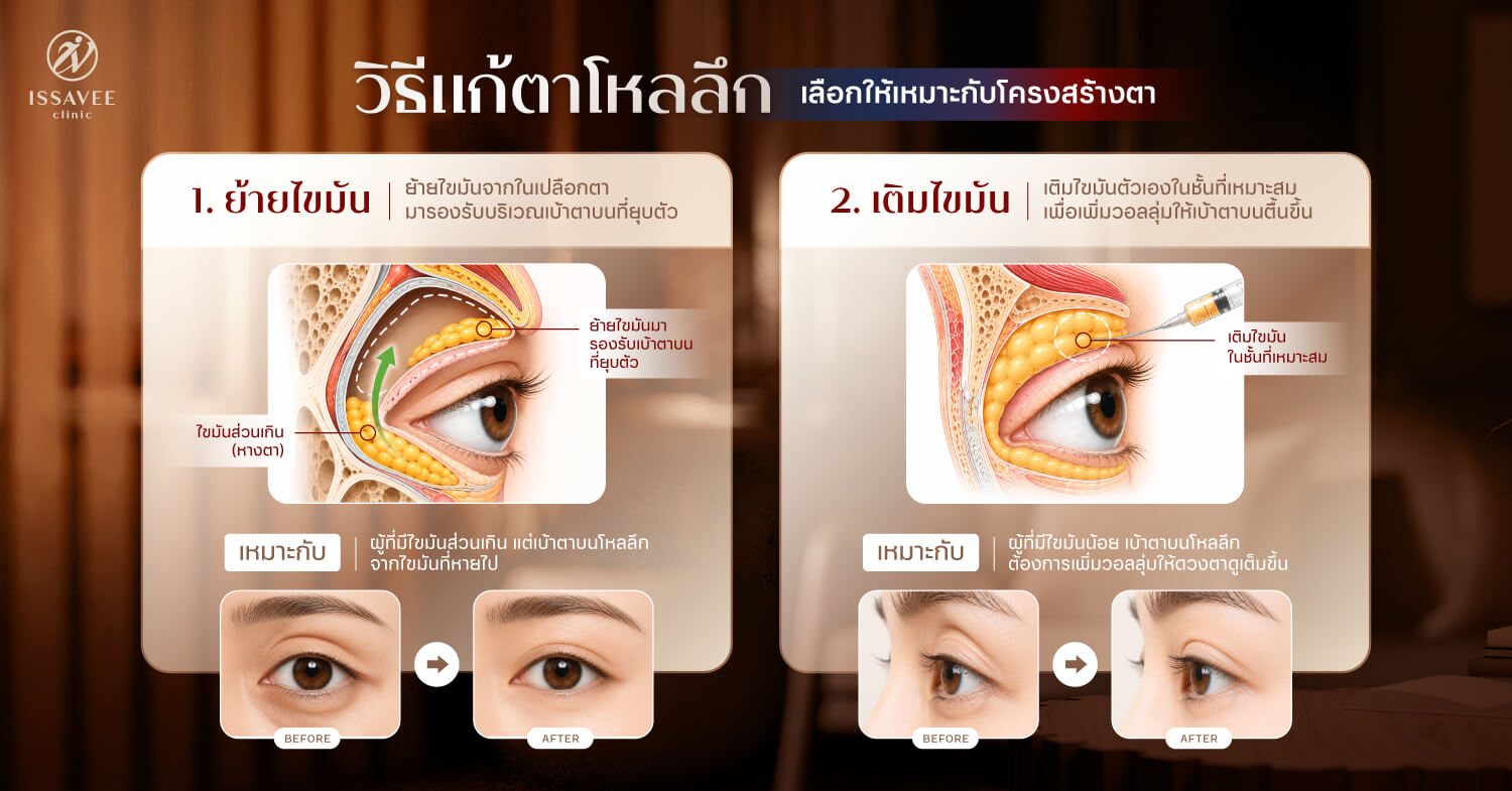 วิธีแก้ตาโหลลึกด้วยการย้ายไขมันและเติมไขมันรอบดวงตา