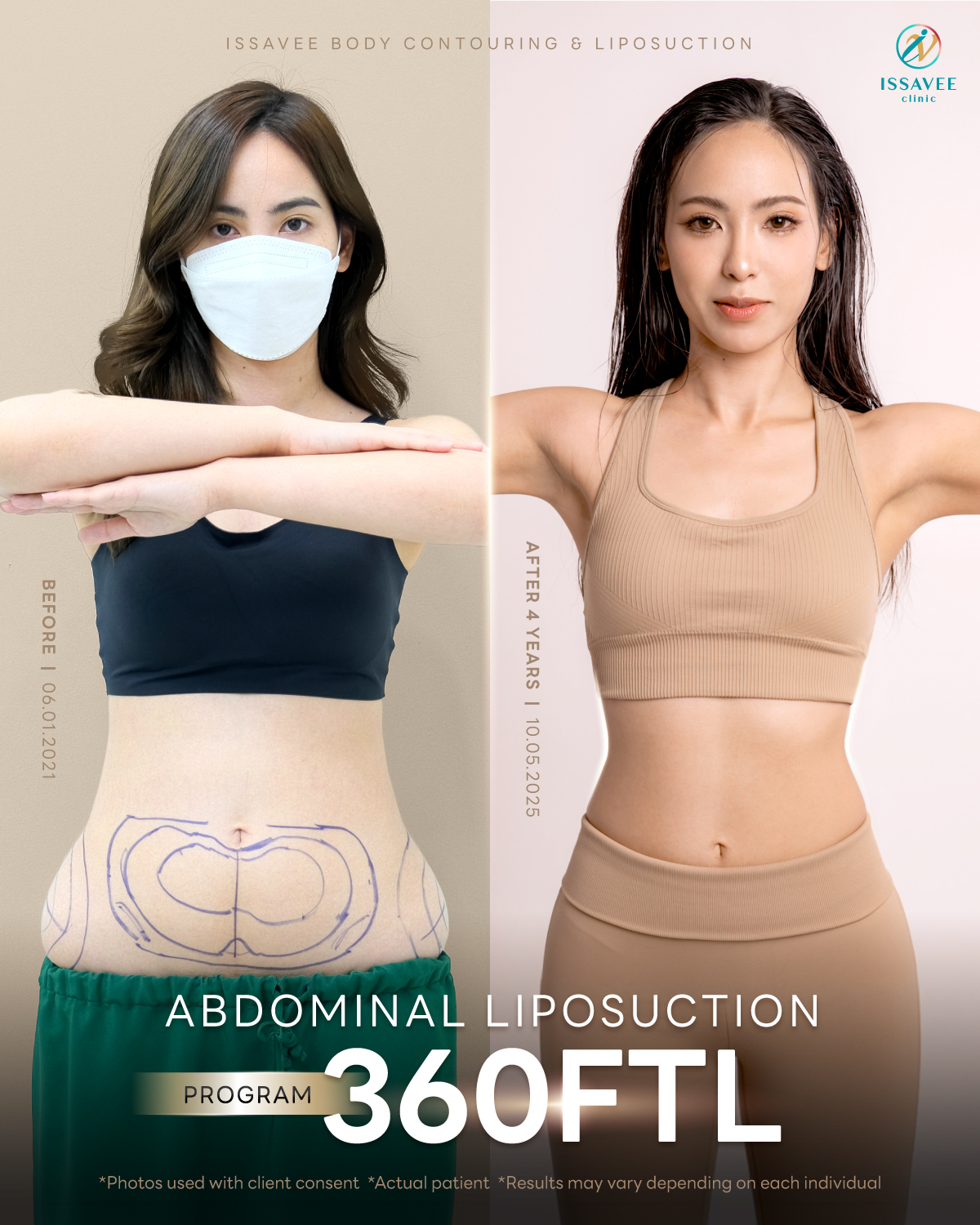 รีวิวดูดไขมันหน้าท้อง